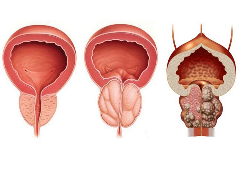 stades de la prostatite et nécessité d'un traitement par Prostavit